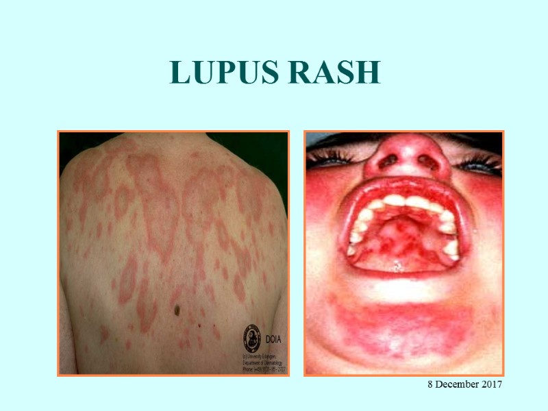 LUPUS RASH 8 December 2017